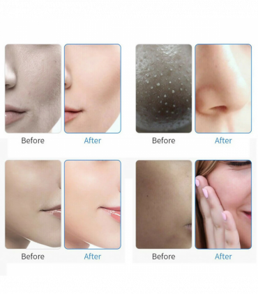 7 in 1 Aqua Hydra Hydro Peeling Facial Dermabrasion Machine Facial Skin Care